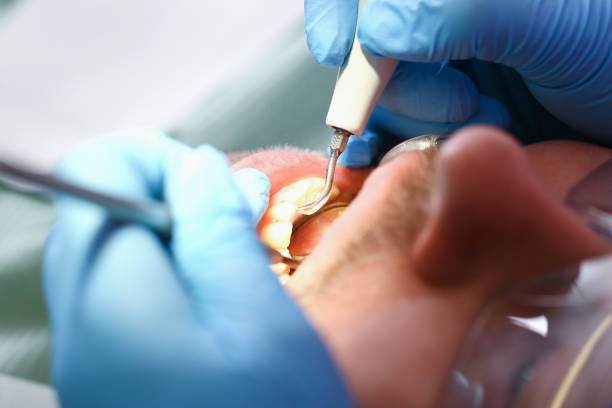 Best Emergency Wisdom Teeth Removal in Dunstan, ME